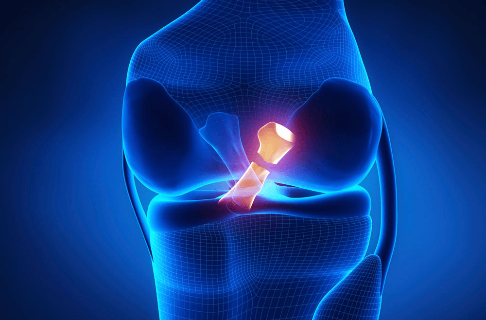 ACL & PCL Meniscus Injuries | Dr. Ankur Singh, Noida
