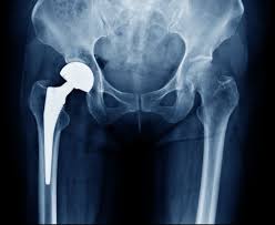 Total Hip Replacement | Dr. Ankur Singh, Noida - Expert orthopedic treatment by Dr. Ankur Singh in Noida