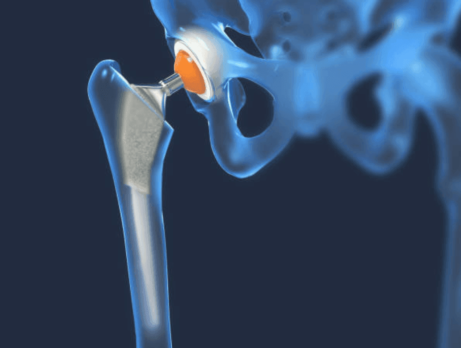 Why choose Dr. Ankur Singh for Total Hip Replacement | Dr. Ankur Singh, Noida in Noida