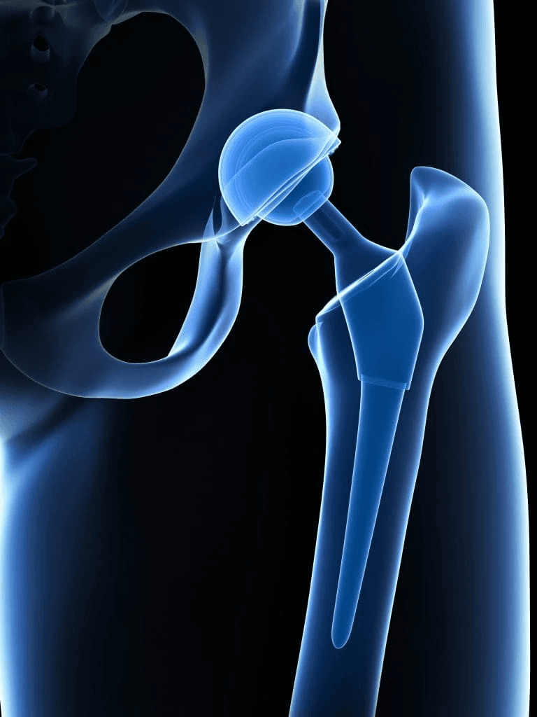 Total Hip Replacement | Dr. Ankur Singh, Noida