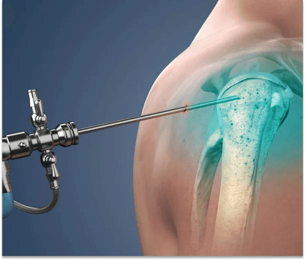 Shoulder Arthroscopy | Dr. Ankur Singh, Noida