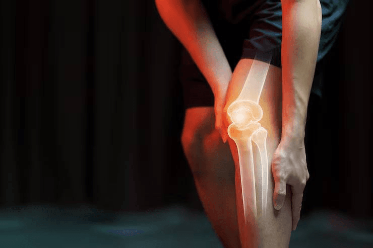 Total Knee Replacement
