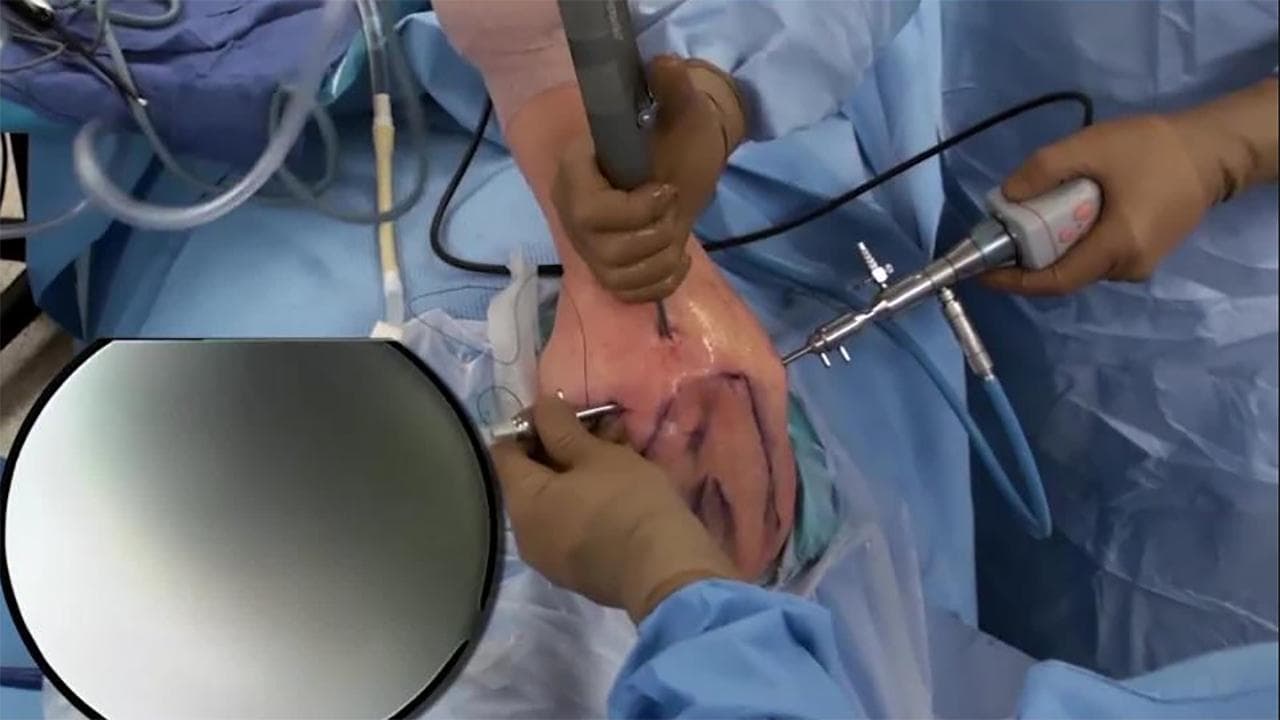 Shoulder Arthroscopy | Dr. Ankur Singh, Noida - Expert orthopedic treatment by Dr. Ankur Singh in Noida
