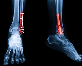 Trauma and Fracture