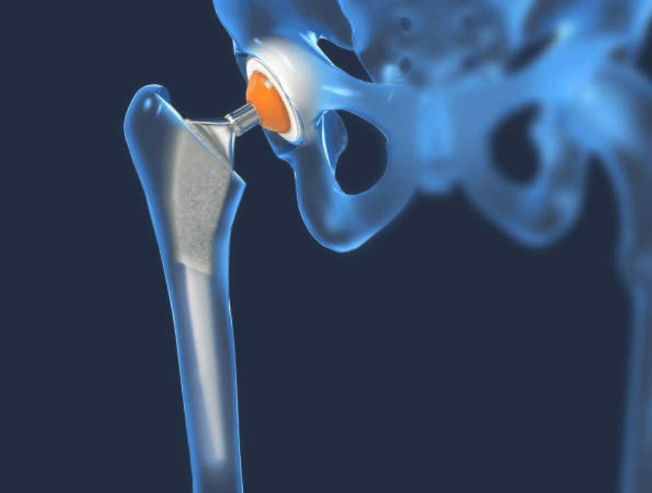 Total Hips Replacement - Why Choose Us