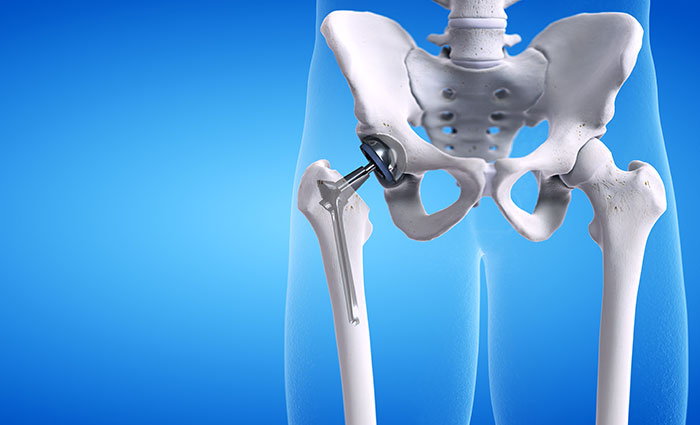 Total Hips Replacement