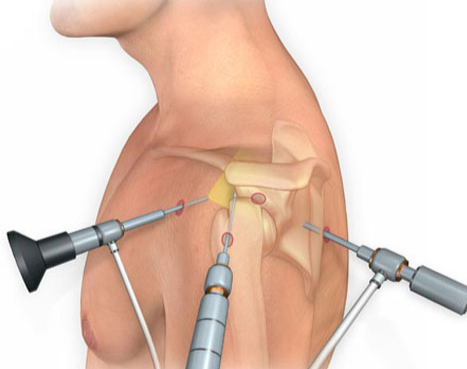Advanced orthopedic specialist Dr. Ankur Singh’s clinic showing ACL, PCL and meniscus injury treatment using minimally invasive technique for knee ligament repair.
